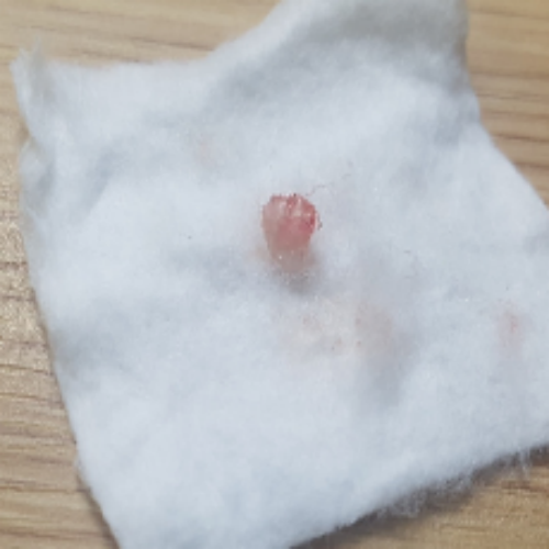 치료 후