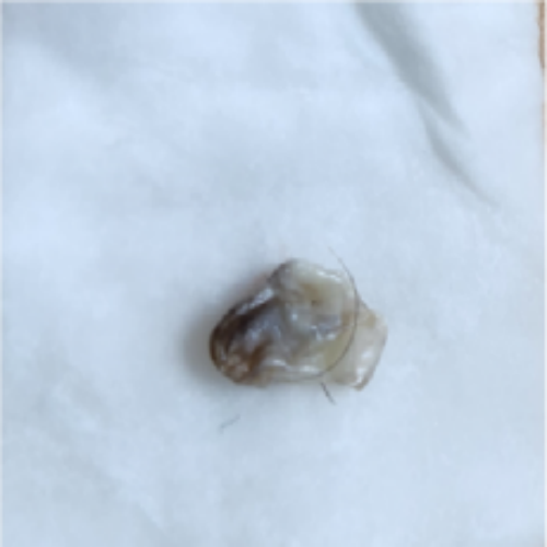 치료 후