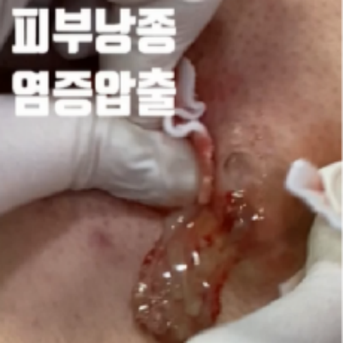 치료 전