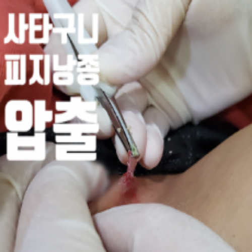 치료 후