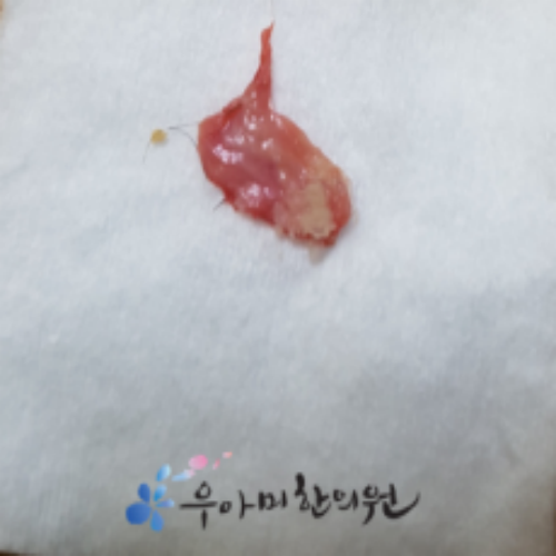 치료 후