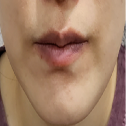 치료 후