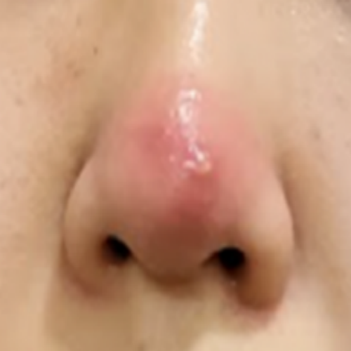 치료 전