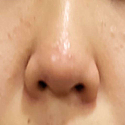 치료 후