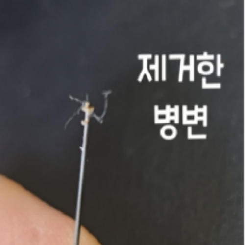 치료 후