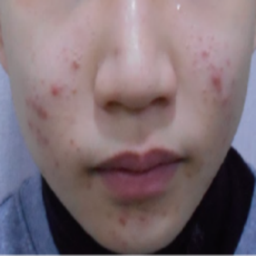 치료 전