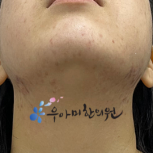치료 후
