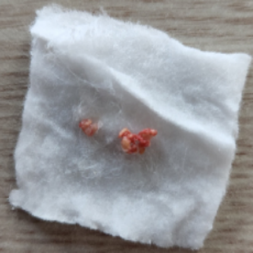 치료 후