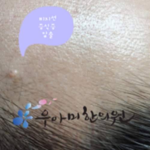 치료 전
