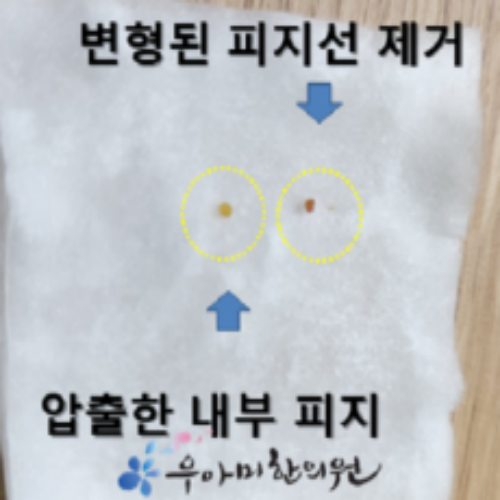 치료 후