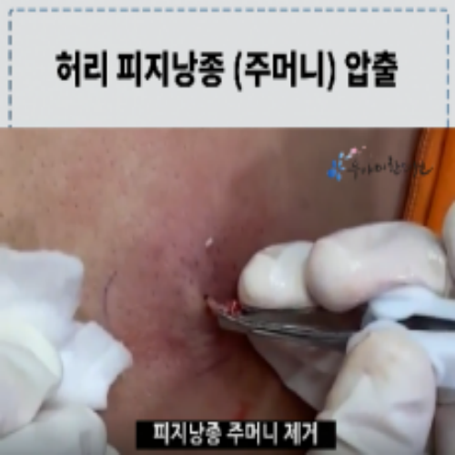 치료 후