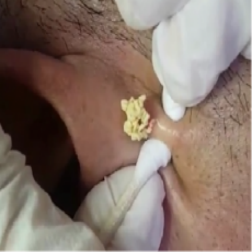 치료 전