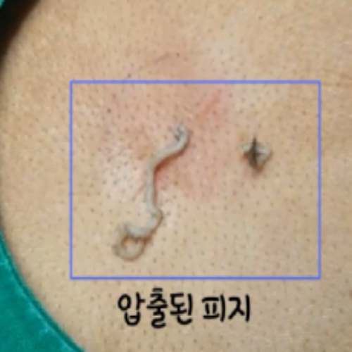 치료 전