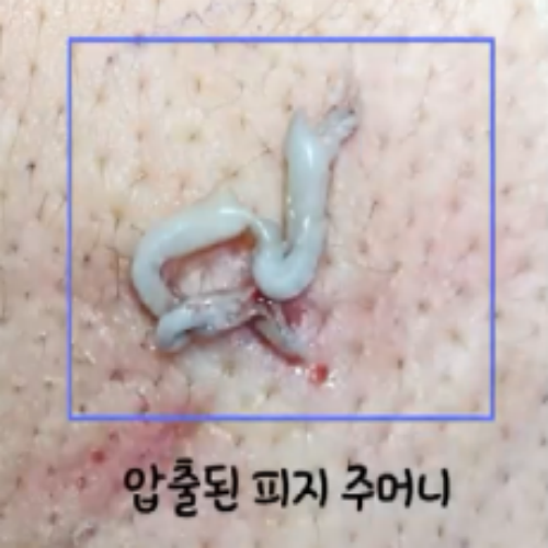 치료 후