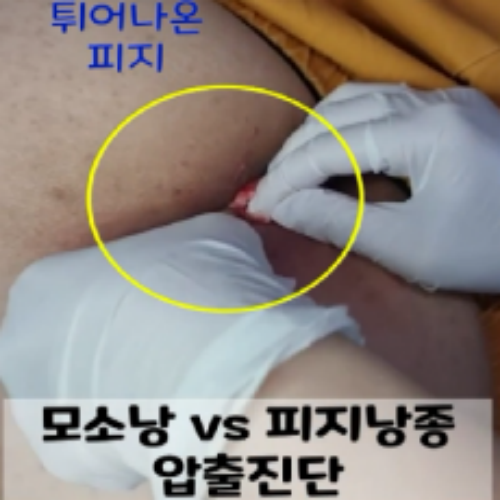치료 전