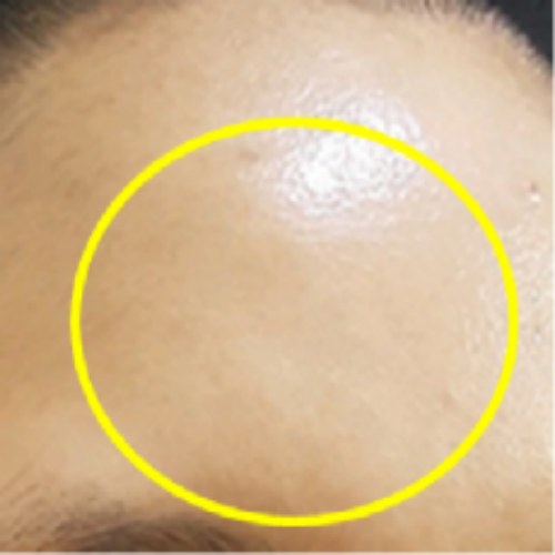치료 후