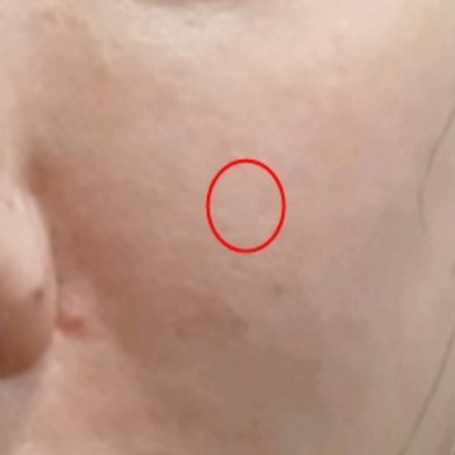 치료 후