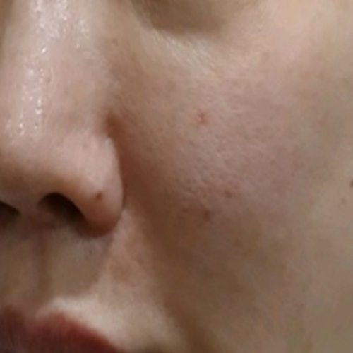 치료 전