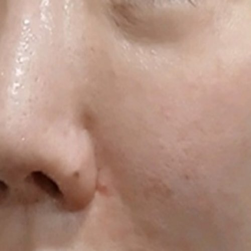 치료 후