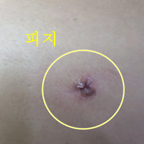 치료 전