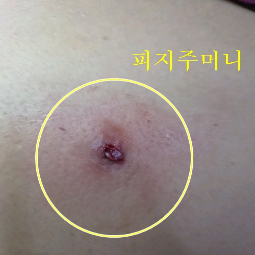 치료 후