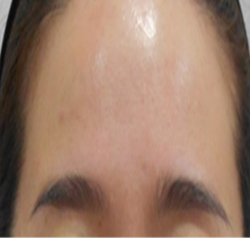치료 후