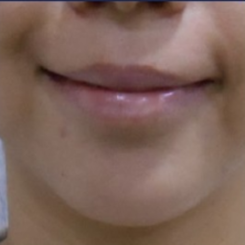 치료 전