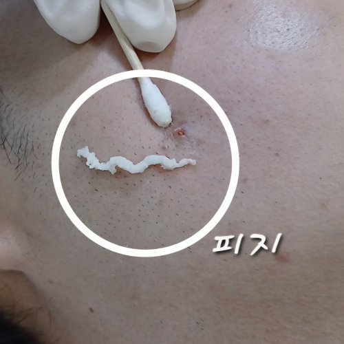 치료 전