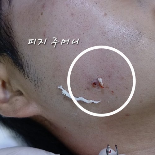 치료 후