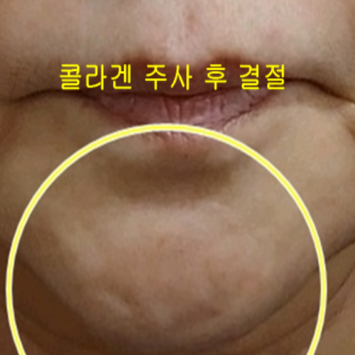 치료 전