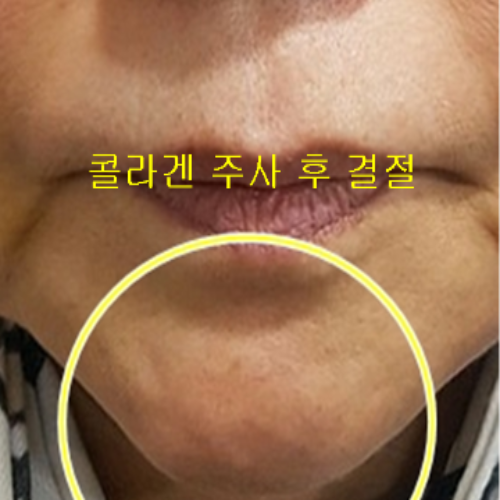 치료 후