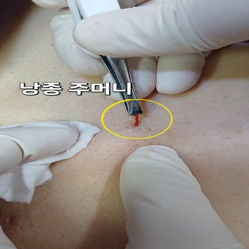 치료 후