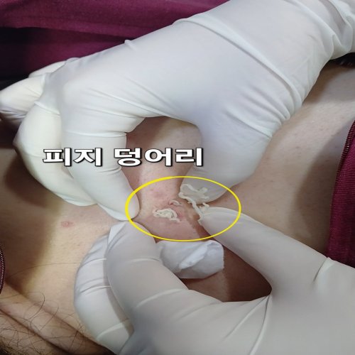 치료 전