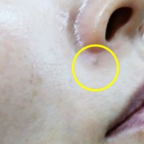 치료 전