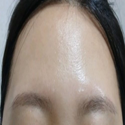 치료 후
