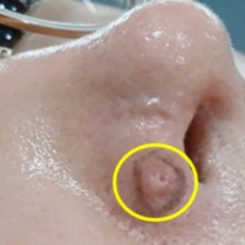 치료 전