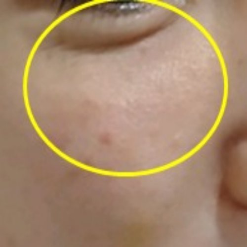 치료 후